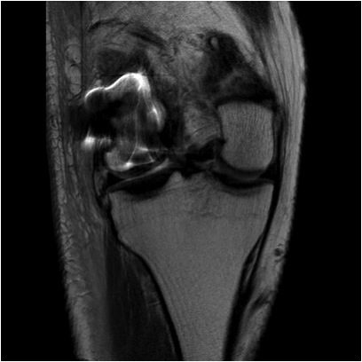 Hoffa Fracture MCL Avulsion MRI 1
